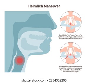 Choking first aid. Heimlich maneuver procedure to remove a foreign object from person airways. Hands placements instruction. Flat vector illustration