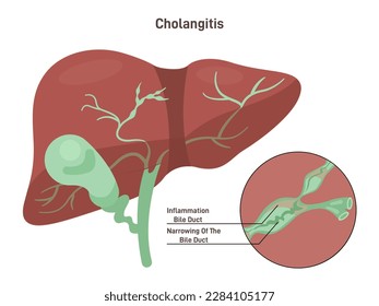 Cholangitis or ascending cholangitis. Infection and imflamation of the bile duct. Human liver with a bile duct and gallbladder. Clinical syndrome. Flat vector illustration