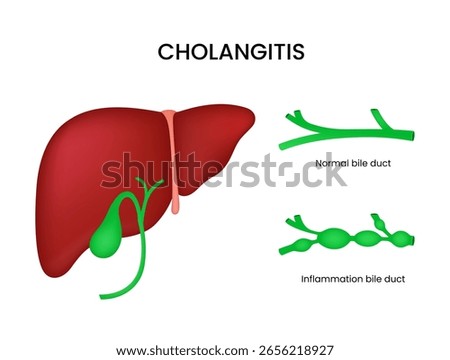 Cholangitis Inflammation of Bile Ducts