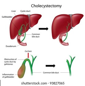 Cholecystectomy Gallbladder Removal Surgery