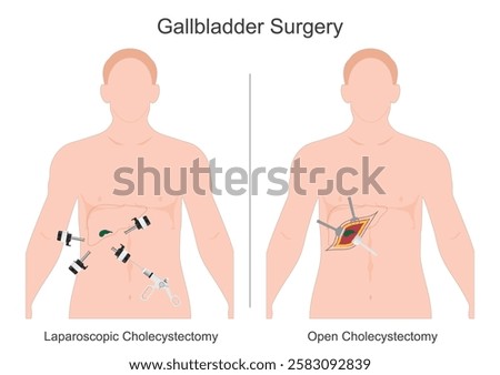 A Cholecystectomy is surgery to remove gallbladder. The operation can be done laparoscopically (keyhole surgery) or as an open Cholecystectomy procedure.medical healthcare, vector illustration.
