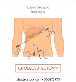 Cholecystectomy - surgical removal of the gallbladder. Laparoscopic incisions. Cartoon vector illustration for medical atlas or educational textbook. 