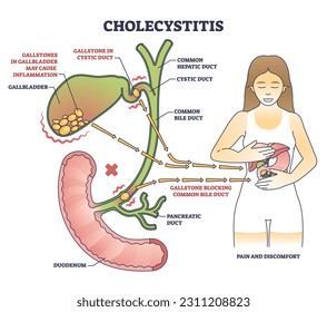 Cholecystitis als Gallenblasenentzündung aus dem Diagramm der blockierten Gallenblase. Bezeichnetes Bildungsprogramm mit medizinischer Krankheit im Verdauungstrakt aus Gallenstein Vektorgrafik. Herzanatomie