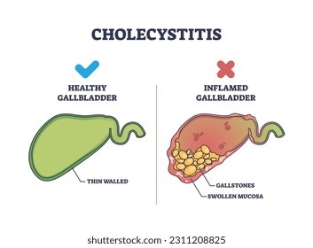 Cholecystitis as inflamed gallbladder compared with healthy outline diagram. Labeled educational scheme with swollen mucosa and gallstones in digestive tract vector illustration. Stomach disease.