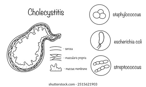 Colecistitis. Inflamación de las paredes de la vesícula biliar debido a una infección. Estructura dibujada a mano de la vesícula biliar y bacterias que conducen a la inflamación del órgano. Ilustración vectorial.