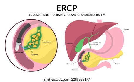 cholecystitis tract infection surgery gallbladder Gallstones choledocholithiasis Endoscopic Retrograde Cholangiopancreatography or ERCP Common cancer pancreatitis cholangitis stone bile duct removal