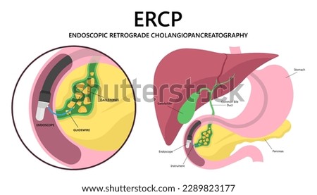 cholecystitis tract infection surgery gallbladder Gallstones choledocholithiasis Endoscopic Retrograde Cholangiopancreatography or ERCP Common cancer pancreatitis cholangitis stone bile duct removal