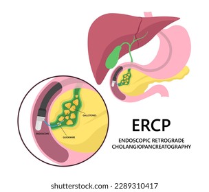 choledocholithiasis Endoscopic Retrograde Cholangiopancreatography ERCP Common stone Gallstones bile duct removal surgery cancer infection cholecystitis tract pancreatitis cholangitis gallbladder