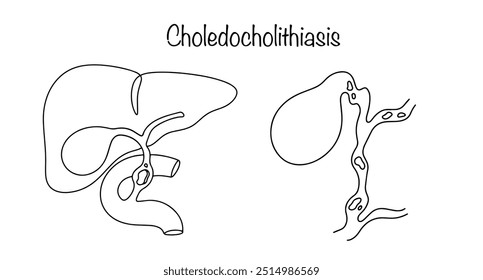 Coledocolitíase. Uma das formas de manifestação da colelitíase, em que as pedras são encontradas não na vesícula biliar, mas nos dutos biliares. Ilustração de vetor desenhada à mão.