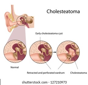 Cholesteatoma