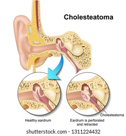 Cholesteatoma human ear anatomy vector illustraton on white background