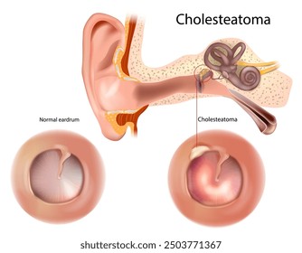 Cholesteatoma and  Normal eardrum. Retracted and perforated eardrum. Otorhinolaryngology Human ear anatomy