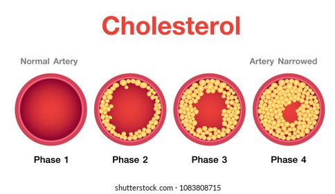 Cholesterol Images, Stock Photos & Vectors | Shutterstock