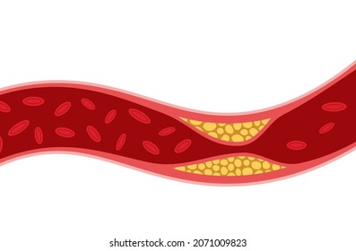 Cholesterol artery thrombosis micro vascular disease. Arteriosclerosis blood vector atherosclerosis risk