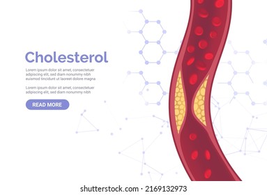 Cholesterol Artery Thrombosis Micro Vascular Disease. Arteriosclerosis Blood Vector Atherosclerosis Risk