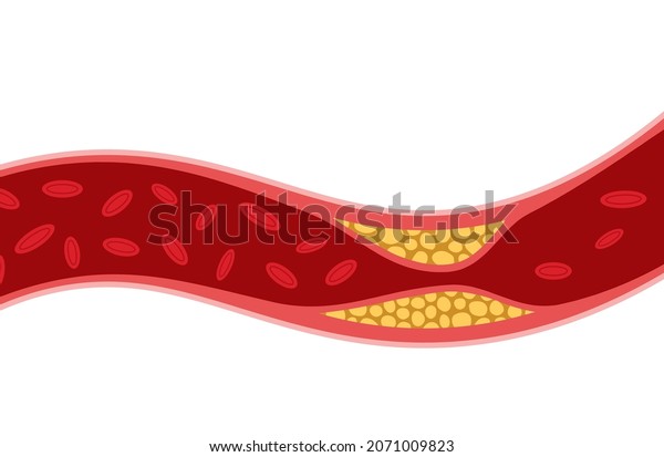 Cholesterol Artery Thrombosis Micro Vascular Disease Stock Vector ...