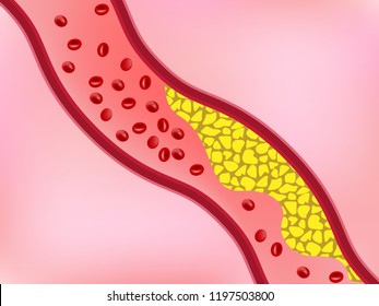 Cholesterol in blood vessel blocking flow of blood, dyslipidermia