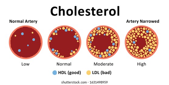Cholesterol C27H46O in artery HDL LDL health risk molecule heart fat vector icons icon sign fun Normal blood flow The accumulation blood vessels Atherosclerotic plaque anatomy Cholestane test