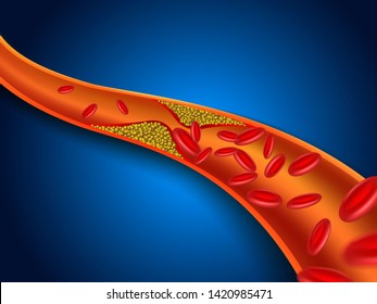 Cholesterol is clogged in the blood vessels.Vector EPS file.