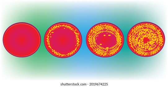 Cholesterol growth of normal artery