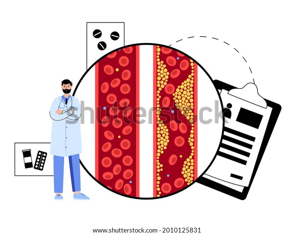 Cholesterol in human blood vessels. Fat\
cells in vein and artery. High ldl and hdl level. Blocked vascular.\
Normal artery and plaque disease. Doctor appointment in clinic or\
lab vector\
illustration