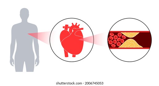 Cholesterol in human blood vessels. Heart logo in man silhouette. Fat cells in vein. High ldl and hdl level. Blocked vascular and plaque in artery. Human body medical poster flat vector illustration