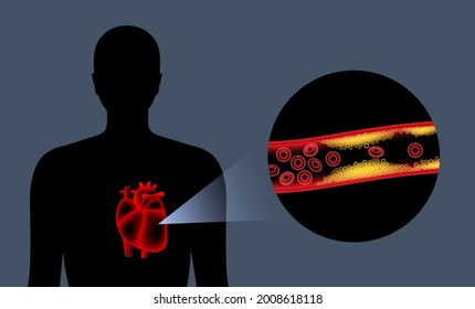 Cholesterol in human blood vessels. Heart logo in man silhouette. Fat cells in vein. High ldl and hdl level. Blocked vascular and plaque in artery. Human body medical poster flat vector illustration
