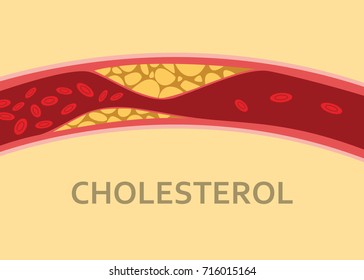 A Cholesterol Human Body Vein With Blood Cell Stream