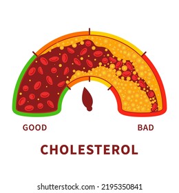 Cholesterol Level On Blocked Blood Vessel Medical Diagram. Meter Gauge Of Bad Hdl Lipoprotein. High And Low Fat Test Indicator. Atherosclerosis Risk. Healthcare Concept. Vector Illustration.