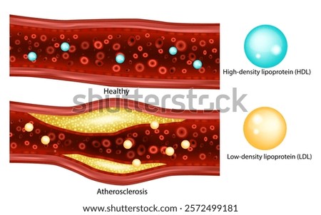 Cholesterol. Low-density lipoprotein (LDL)High-density lipoprotein (HDL). Atherosclerosis, arterial plaque 