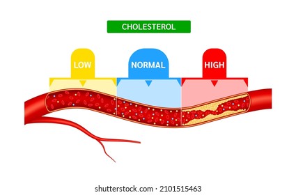 Cholesterol Meter Or Scale Comparison With HDL High Density Lipoprotein And LDL Low Density Lipoprotein. Normal Blood Flow And Cholesterol Artery Thrombosis Disease. ​​Medicine And Health Vector.