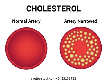 Colesterol Arteria Normal Arteria Estrechada Diseño Científico Diagrama de ilustración vectorial