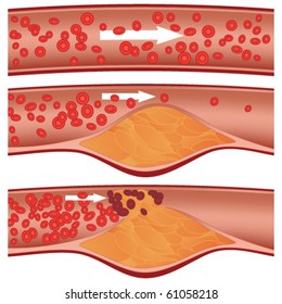 Cholesterol plaque in artery (atherosclerosis) illustration. Top artery is healthy. Middle & bottom arteries show plaque formation, rupturing, clotting & blood flow occlusion.