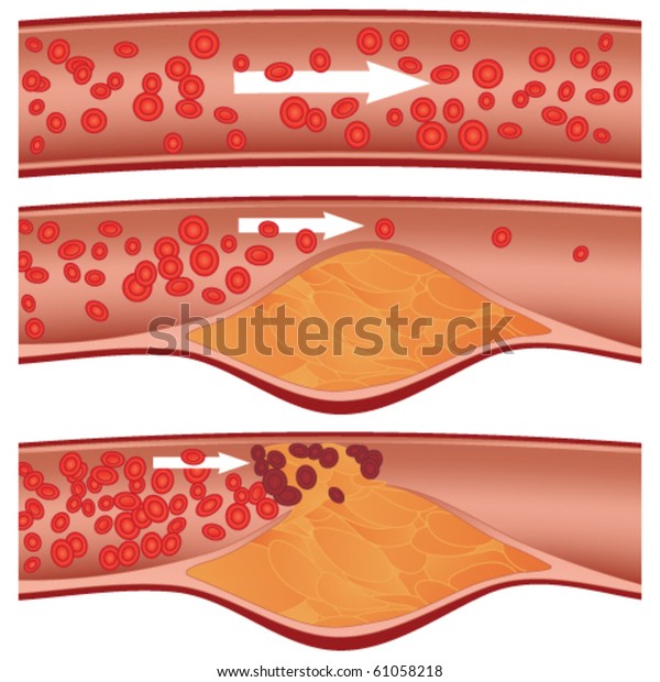 動脈内のコレステロール粥 アテローム性動脈硬化症 のイラスト 上部動脈は健康です 中央 のベクター画像素材 ロイヤリティフリー