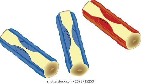 Cholesterol plaque building up inside blood vessel, causing artery stenosis and blood flow restriction