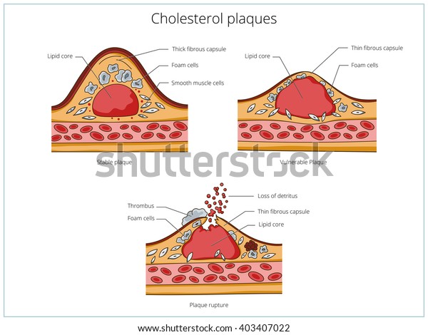 Cholesterol plaque\
structure and thrombus formation medical educational science vector\
illustration. Vascular\
anatomy