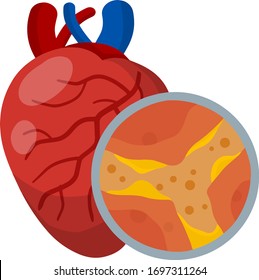 Blood Blockage High Res Stock Images Shutterstock