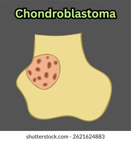chondroblastoma non cancerous bone tumor in long bone illustration useful for educational and healthcare industries orthopedics