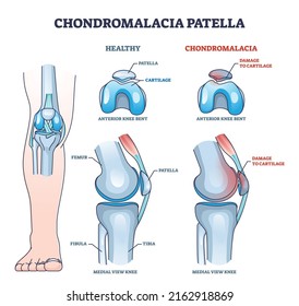 Chondromalacia patella knee breakdown compared with healthy outline diagram. Labeled educational kneecap tissue damage with cartilage problem and anatomical leg joint structure vector illustration.