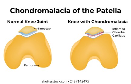 Condromalacia de la Ciencia de la Rótula Diseño Diagrama de Ilustración vectorial