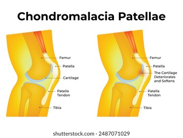Chondromalacia Patellae Science Design Vector Illustration Diagram