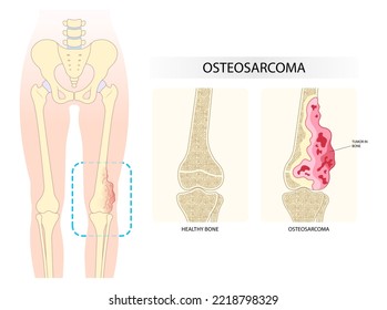 Rechtes Knie mit Osteosarkom-Zellen, die sich auf den Oberschenkel ausbreiten und zu einer ungewöhnlichen Knochenstruktur führen