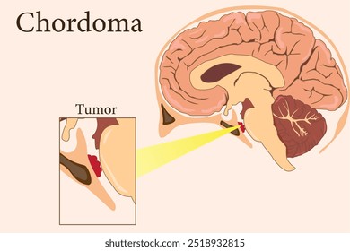 Chordoma is a rare malignant tumor originating from notochordal remnants, primarily affecting the spine. eps 10