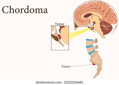 Chordoma is a rare malignant tumor originating from notochordal remnants, primarily affecting the spine. Chordoma tumor in the coccyx and skull. eps 10