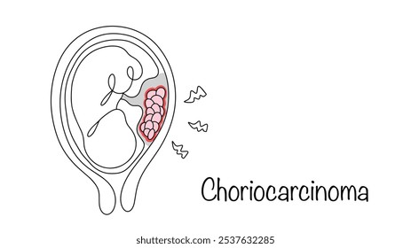 Choriocarcinoma. A hand-drawn illustration of an embryo in the uterus whose placental cells contain cancer. Abnormal cells in the placenta are highlighted in color. Isolated vector for different uses.