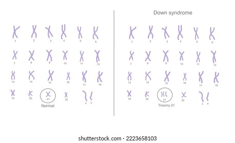 The chromosome 21 are changed the copy number from normal (2 copies) to abnormal (extra) chromosome (3 copies) that call Trisomy 21: Down syndrome svg