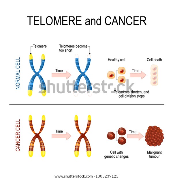 健康な細胞とがん細胞のための染色体とテロメア 通常のセルでは セルが分割されるたびに テロメアが短くなります がん細胞では テロメアは変化しない がんの発達 のベクター画像素材 ロイヤリティフリー