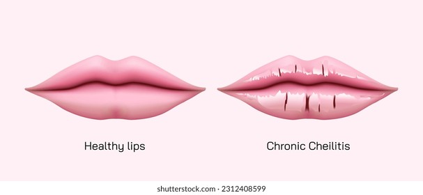 Chronic angular cheilitis problem. Dry chapped lips vector illustration. symptoms of Ripped lips skin. Disease of the mouth. sore lips, skin flakes. Vector illustration. lips ulcer and cancer symptoms