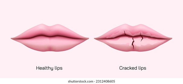 Chronic angular cheilitis problem. Dry chapped lips vector illustration. symptoms of Ripped lips skin. Disease of the mouth. sore lips, skin flakes. Vector illustration. lips ulcer and cancer symptoms