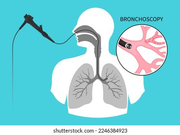 Chronic asthma test medical chest X RAY for Bronchioles tumor cancer malignant cell surgical with flexible fiber optic guided lymph node masses mucus plug bronchi washing